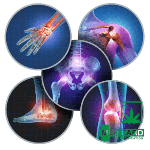 Medical Marijuana In the Treatment of Arthritis